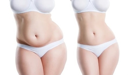 Abdominoplastia - Vista Frontal - Dr. Jorge Urenda