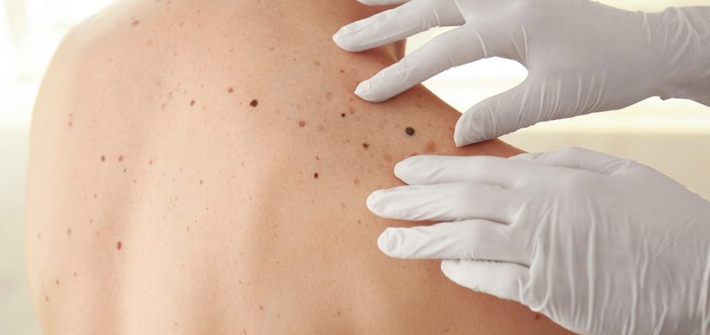Cáncer de piel - Dr. Jorge Urenda- Diagnostico_1